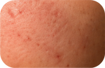 Repairs Skin Barrier